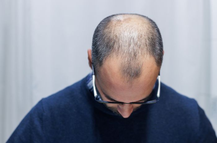Apa dan Bagaimana Mengatasi Alopecia?