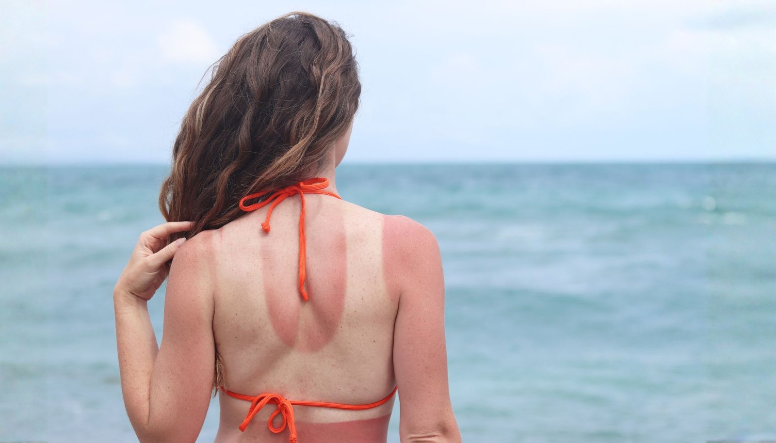 Kulit Terbakar Matahari Bisa Pulih Sendiri? Benarkah?